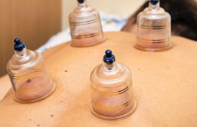 Cupping Therapy img